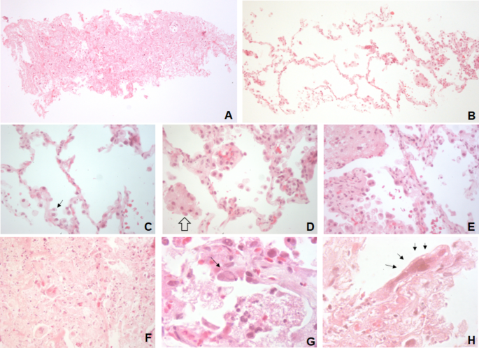 Mpox as AIDS-defining event with a severe and protracted course