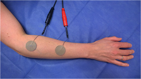 RISE Stimulator - Electrotherapy Device for Denervated Muscle