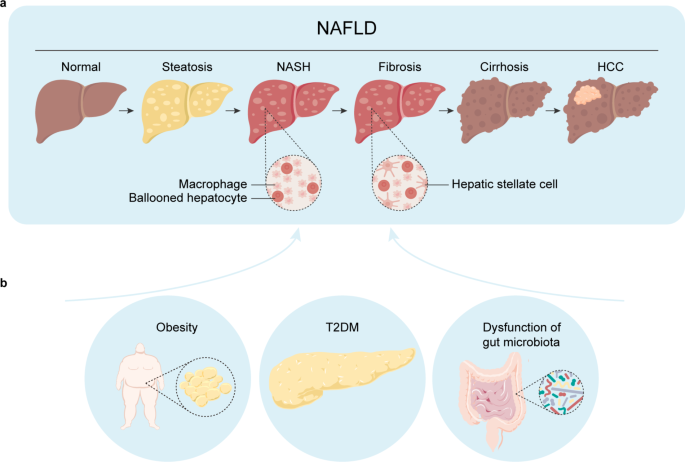 NAFLD & NASH as a metabolic disease