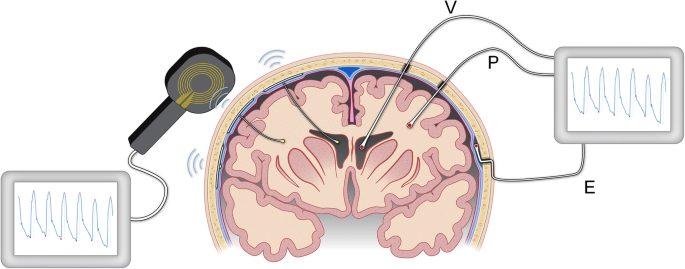 Measuring intracranial pressure by invasive, less invasive or non-invasive  means: limitations and avenues for improvement | Fluids and Barriers of the  CNS | Full Text