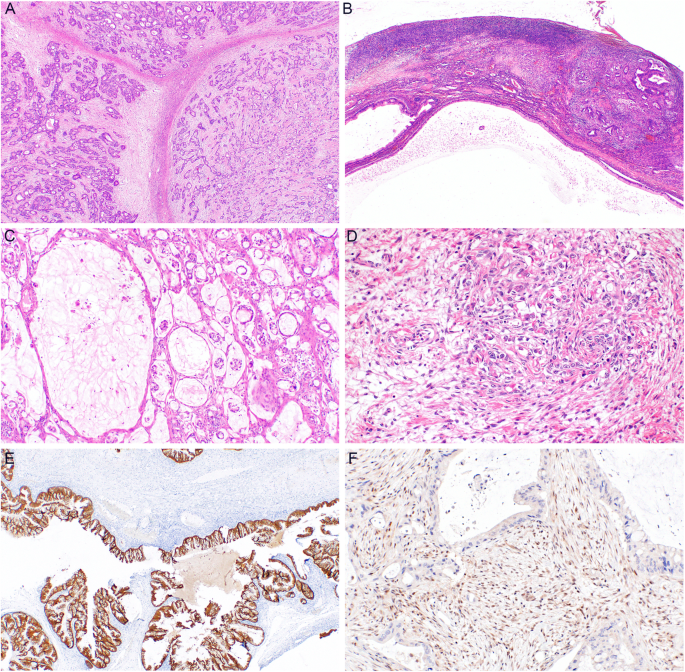 Clinicopathological Characteristics and Prognosis of 91 Patients with  Seromucinous and Mucinous Borderline Ovarian Tumors: a Comparative Study