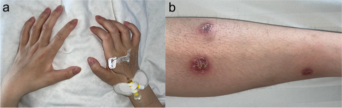 NK/T-cell lymphoma with rash and peripheral neuropathy as the