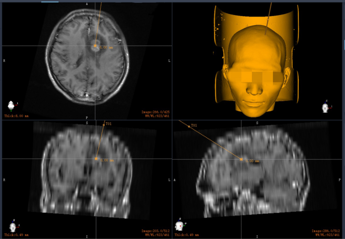 Difficulty in diagnosing intracranial infection caused by Mycobacterium avium in an AIDS patient: case report and review of the literature