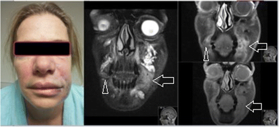 MRI in detecting facial cosmetic injectable fillers | Head & Face Medicine  | Full Text