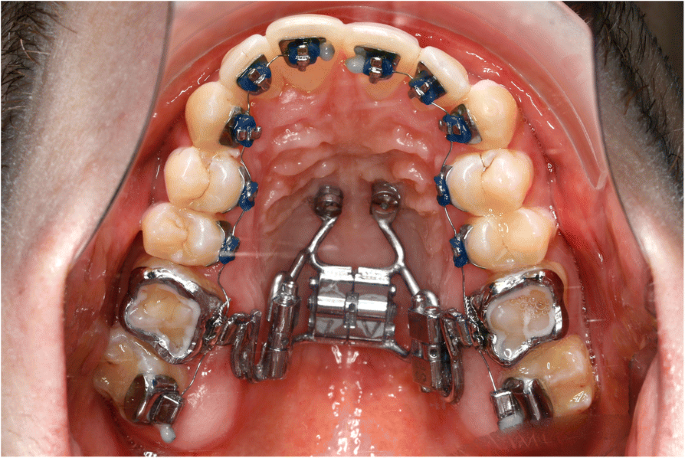 What is a Rapid Maxillary Expander?