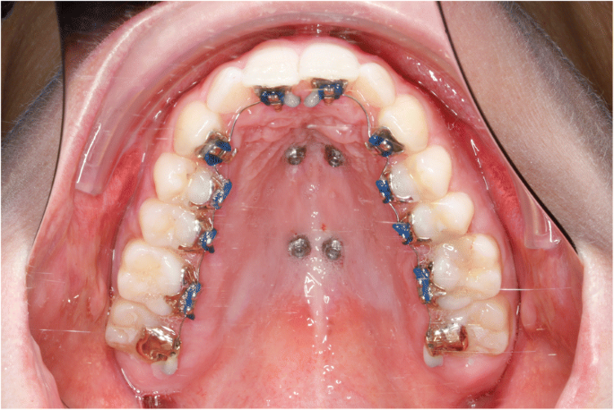 Palate Expansion Surgery - Understanding the Procedure, Benefits, and Recovery