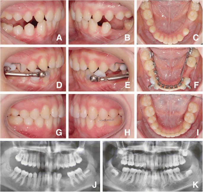 PDF) Mesiodistal angulation of the lateral teeth to the functional occlusal  plane in normal occlusions