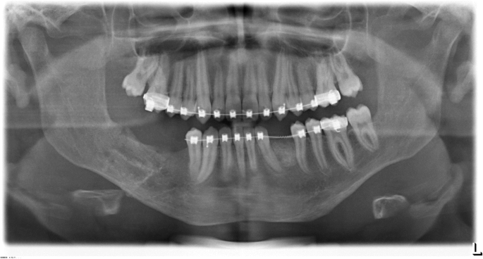 Multidisciplinary oral rehabilitation of an adolescent suffering from  juvenile Gorlin-Goltz syndrome – a case report | Head & Face Medicine |  Full Text