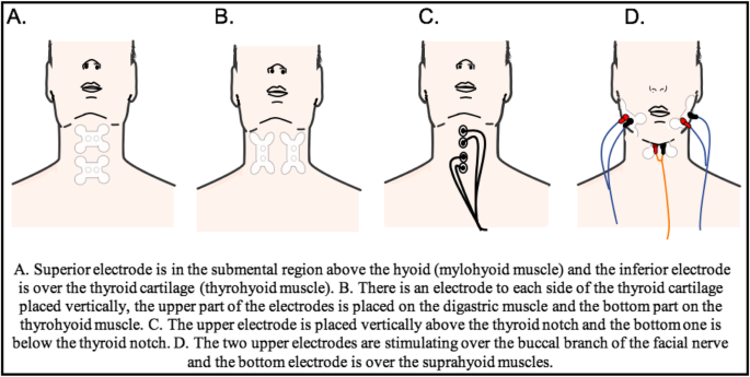Daytime OSA Therapy: Intraoral Neuromuscular Electrical Stimulation and its  Mechanism of Action 