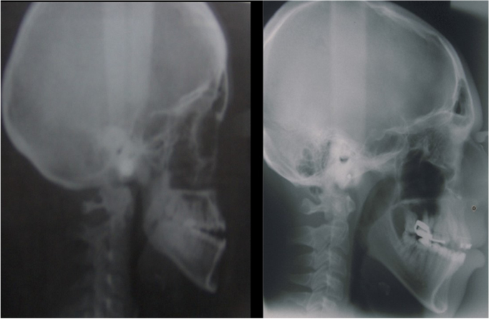 Facial dysmorphism, skeletal anomalies, congenital glucoma