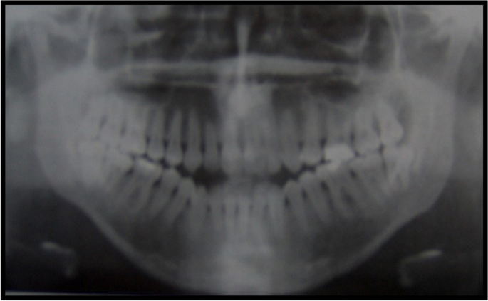 Facial dysmorphism, skeletal anomalies, congenital glucoma