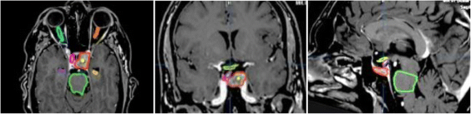 Gamma Knife radiosurgery for acromegaly: Evaluating the role of