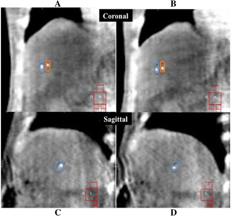 Tumor motion changes in stereotactic body radiotherapy for liver tumors: an  evaluation based on four-dimensional cone-beam computed tomography and  fiducial markers, Radiation Oncology