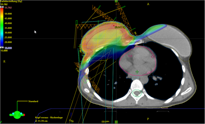 External-beam partial breast irradiation in a supine versus prone position  after breast-conserving surgery for Chinese breast cancer patients