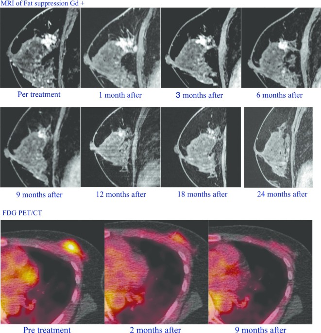 The clinical picture of the left breast at one-month post-surgery