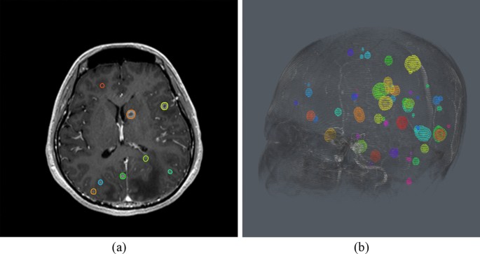 Automated detection of brain metastases on non-enhanced CT using