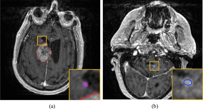 Automated detection of brain metastases on non-enhanced CT using