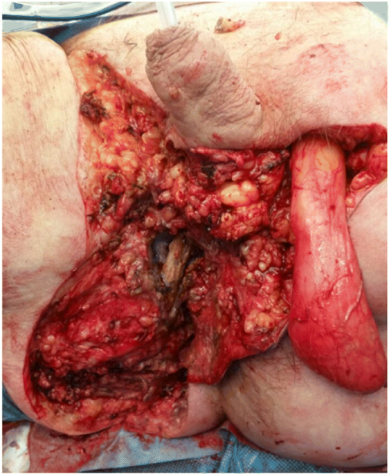 A contemporary case series of Fournier's gangrene at a Swiss tertiary care  center—can scoring systems accurately predict mortality and morbidity? |  World Journal of Emergency Surgery | Full Text