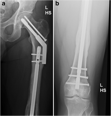 Post-Traumatic Knee Replacement Without Removing Hardware