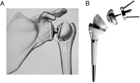 Prosthesis design and placement in reverse total shoulder arthroplasty |  Journal of Orthopaedic Surgery and Research | Full Text