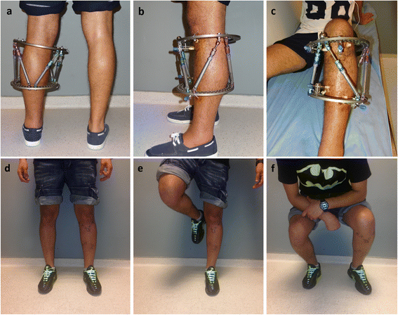 Llizarov Tibia Ring External Fixator Lengthening for Delayed