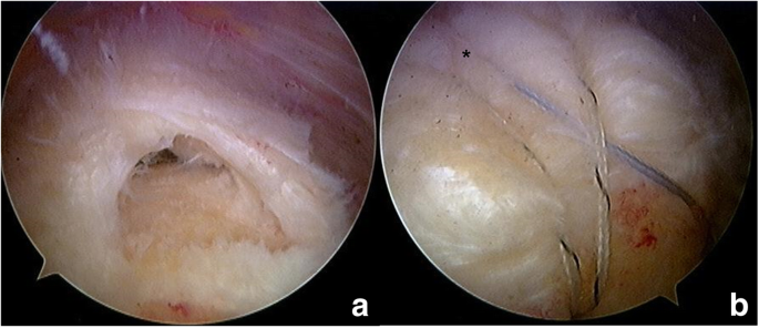Clinical outcomes and repair integrity of arthroscopic rotator cuff repair  using suture-bridge technique with or without medial tying: prospective  comparative study, Journal of Orthopaedic Surgery and Research