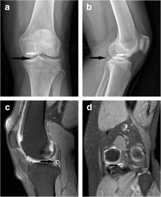 Arthroscopic removal of loose bodies using the accessory portals in the  difficult locations of the knee: a case series and technical note | Journal  of Orthopaedic Surgery and Research | Full Text