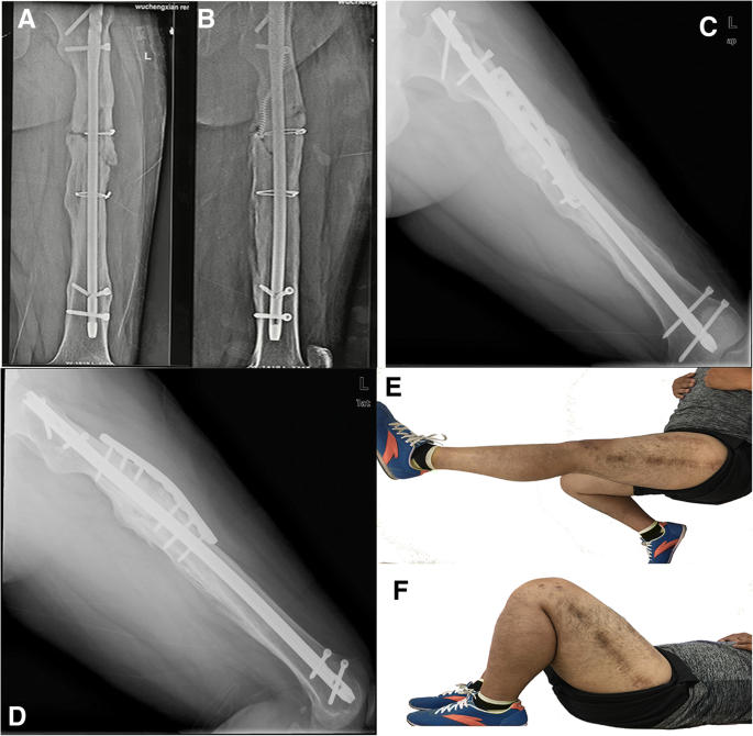 Lengthening of the Femur over an Existing Intramedullary Nail