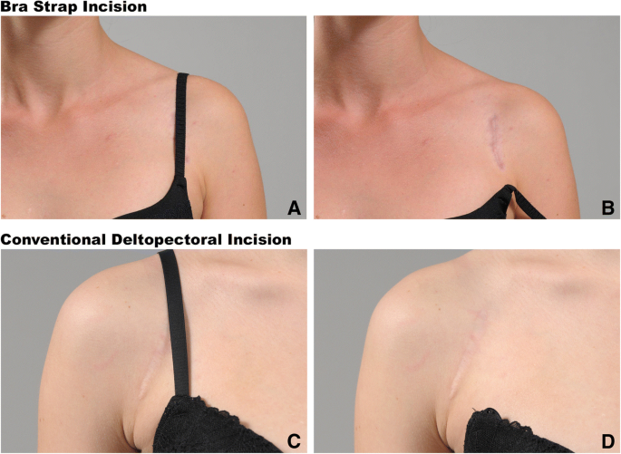 The bra strap incision in the open Latarjet procedure, Journal of  Orthopaedic Surgery and Research