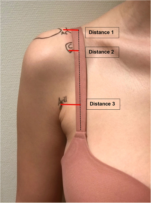 The bra strap incision in the open Latarjet procedure