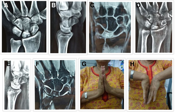 https://media.springernature.com/m685/springer-static/image/art%3A10.1186%2Fs13018-019-1152-7/MediaObjects/13018_2019_1152_Fig3_HTML.png