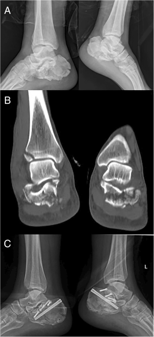 Steinmann pin retractor-assisted reduction with circle plate fixation via  sinus tarsi approach for intra-articular calcaneal fractures: a  retrospective cohort study | Journal of Orthopaedic Surgery and Research |  Full Text