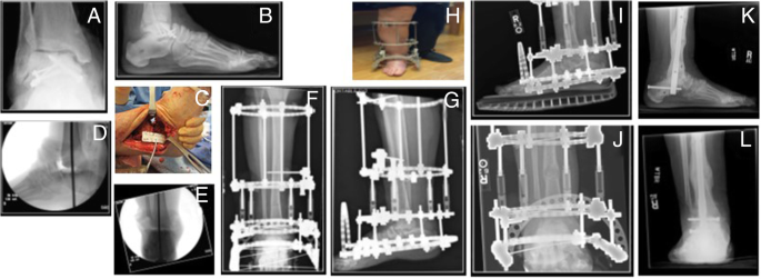 Minimally invasive distal tibial osteotomy and correction of deformity with  the Taylor Spatial Frame – Orthoracle LuanMD