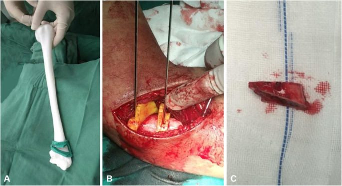 Revista Brasileira de Ortopedia - Treatment of Distal Radio Vicious  Consolidation: Corrective Osteotomy Through 3D Printing  Prototyping<sup>*</sup>