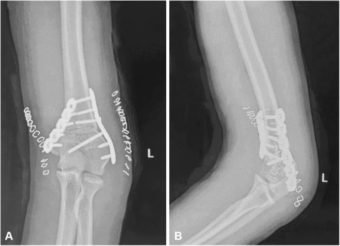 Revista Brasileira de Ortopedia - Treatment of Distal Radio Vicious  Consolidation: Corrective Osteotomy Through 3D Printing  Prototyping<sup>*</sup>