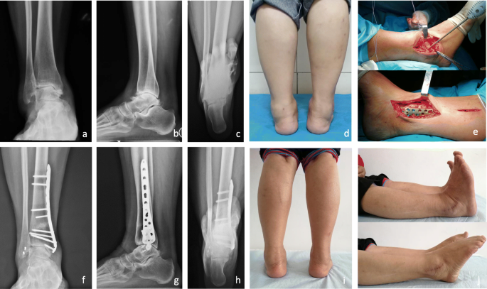 Osteoarthritis of the ankle: methods for joint-preservation