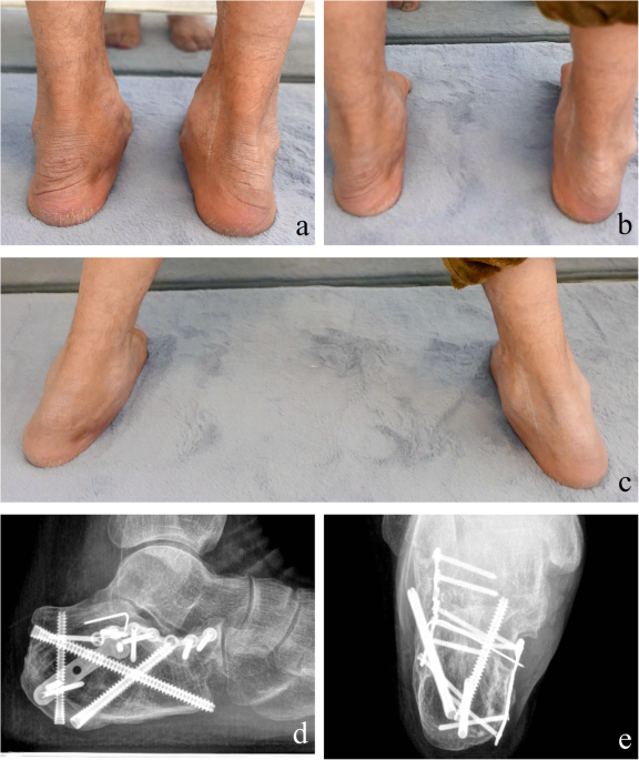An avulsion fracture of the calcaneal tuberosity: delay of treatment causes  the 'Achilles heel' of optimal recovery | BMJ Case Reports
