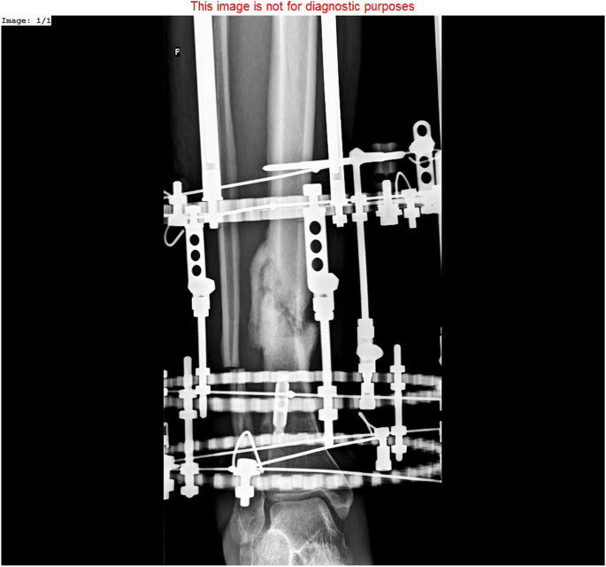 The outcomes of Ilizarov treatment in aseptic nonunions of the tibia  stratified by treatment strategies and surgical techniques