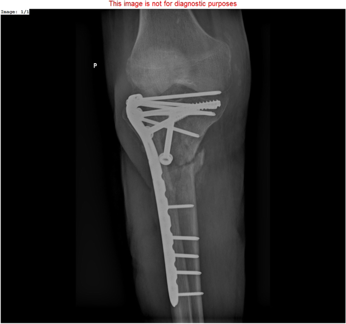 The outcomes of Ilizarov treatment in aseptic nonunions of the tibia  stratified by treatment strategies and surgical techniques