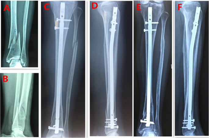 Figure 1 from Advances in Intramedullary Nailing: Suprapatellar Nailing of  Tibial Shaft Fractures in the Semiextended Position. | Semantic Scholar