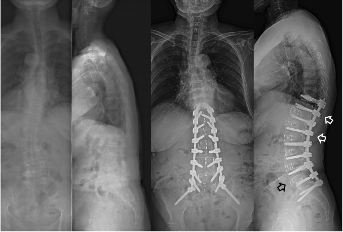PDF) A review of minimally invasive techniques for correction of adult  spine deformity