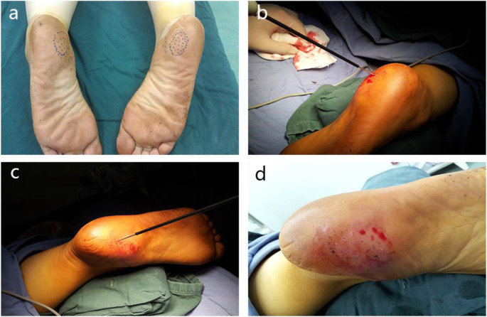Minimally Invasive Joint Clean-Up – Cheilectomy Procedure | District Foot &  Ankle