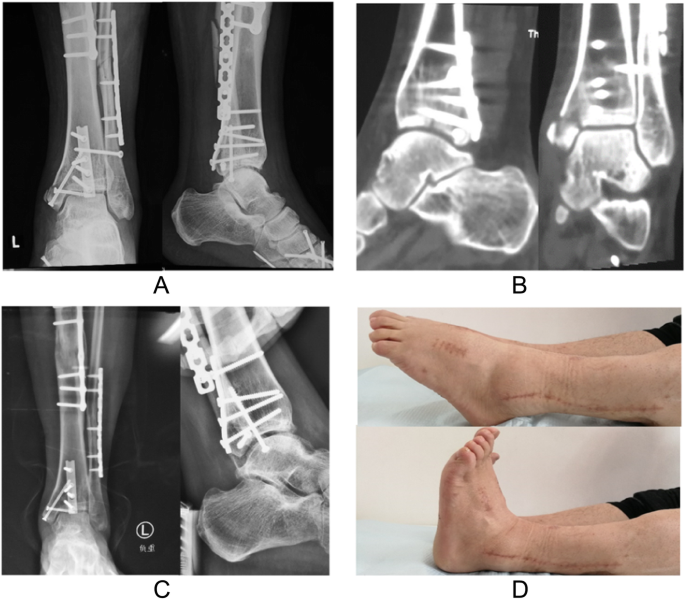 A fibular notch approach for the treatment of ankle fractures involving the  distal tibial plafond, Journal of Orthopaedic Surgery and Research