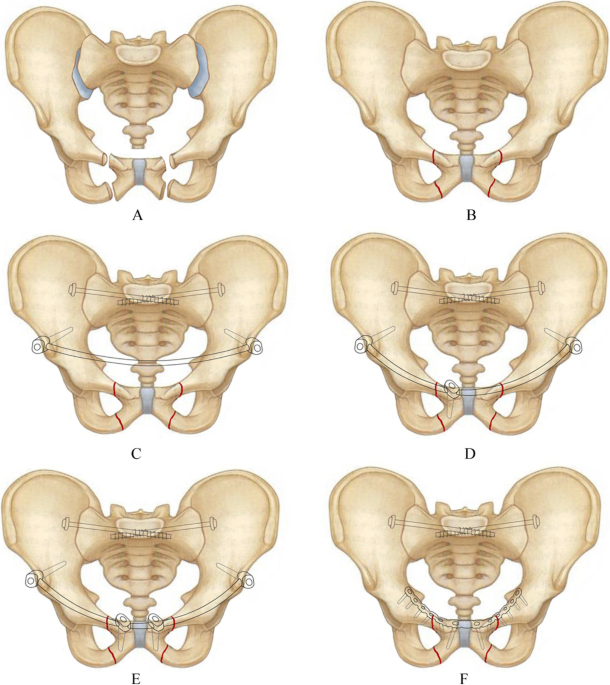 Complex Fracture Of The Pelvis: Do You Need An Orthopedic Surgeon? - Heiden  Orthopedics