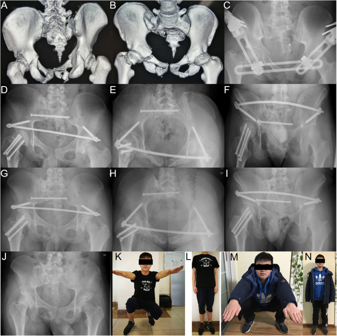 Fractures of the pelvic ring - ScienceDirect