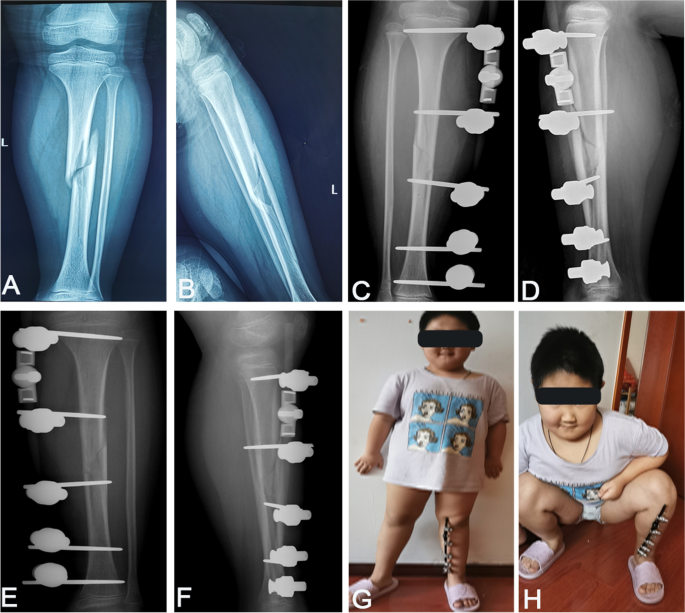 2/3 Ring Fixator For Tibial & Femur Fracture - Orthopedic Drills