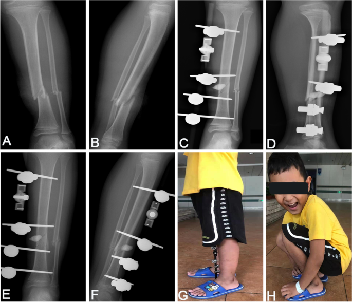 Orthopedic Instrument Trauma Tibial External Fixator System for Tibia  Fracture - China Synth External Fixation, External Fixator