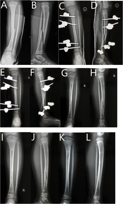 Failure of Intramedullary Expandable Tibial Nail and Fragmentation During  Extraction