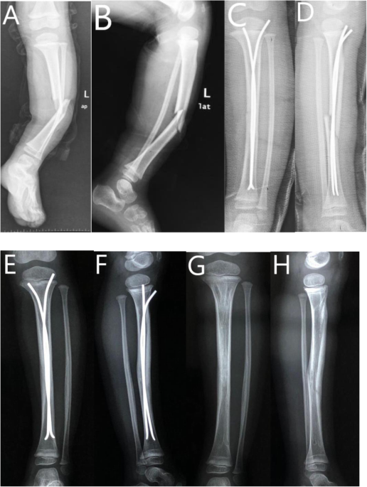 PDF] How safe is titanium elastic nail application in the surgical  treatment of tibia fractures in children? | Semantic Scholar