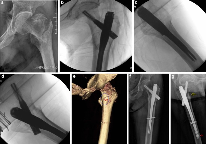 A rare complication of pelvic perforation by an excessive medial slide of  the helical blade after treatment of an intertrochanteric fracture with  proximal femoral nail anti-rotation: A case report and literature review |